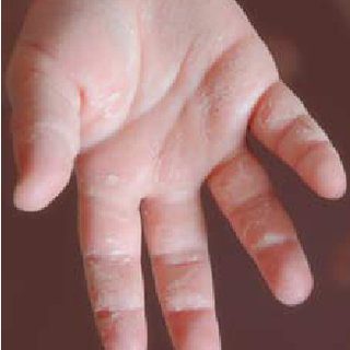 Peeling Of The Skin On The Hands Causes And Treatment Video Healthy