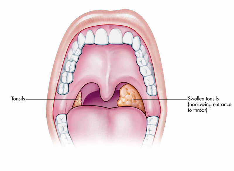 Acute Tonsillitis In Adults Healthy Food Near Me