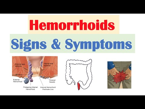 Hemorrhoids Signs &amp; Symptoms | Internal vs. External Hemorrhoid Symptoms | Hemorrhoidal Disease