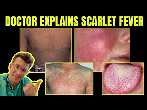 Doctor explains SCARLET FEVER (Group A Streptococcal disease) - CAUSES, SYMPTOMS &amp; TREATMENT