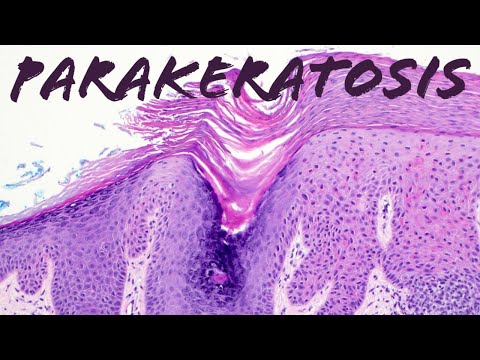 What is Parakeratosis &amp; Why does it happen? (Actinic keratosis vs Lichen simplex chronicus)