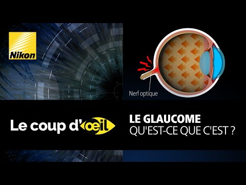 Le glaucome, qu&#039;est-ce que c&#039;est ?