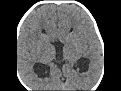 Heterotopic Gray Matter