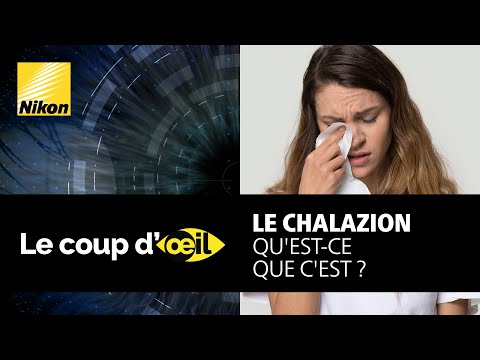 Le chalazion, qu&#039;est-ce que c&#039;est ?