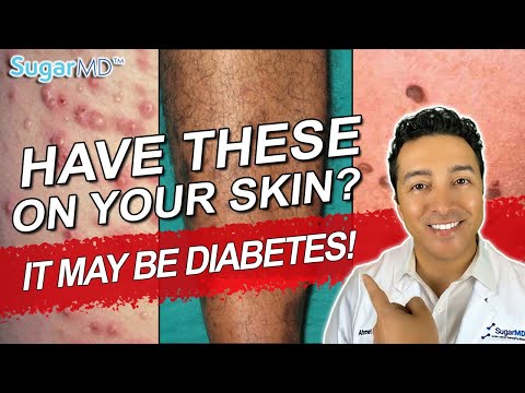 12 Diabetic Skin Problems &amp; Top Signs of Diabetes on The Skin!