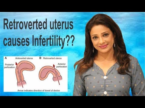 Retroverted Anteverted Uterus??
