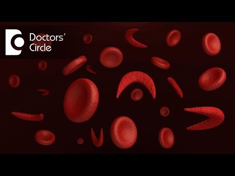 What is management of Anisocytosis Hypochromic Anemia?-Dr. Surekha Tiwari