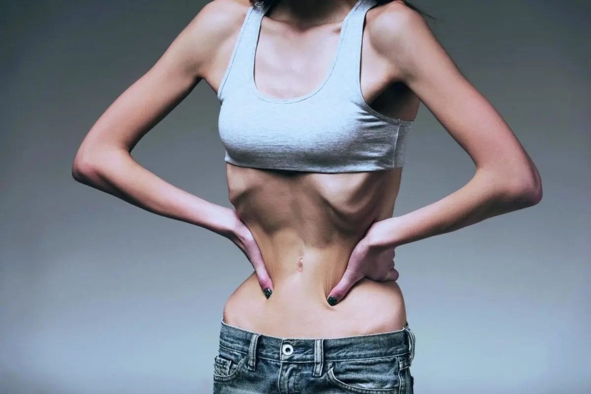 Eating disorders: anorexia