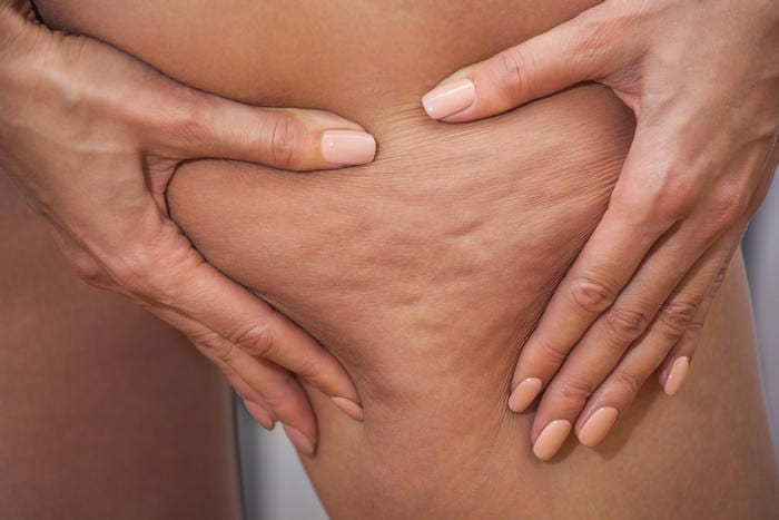 8 foods that trigger cellulite