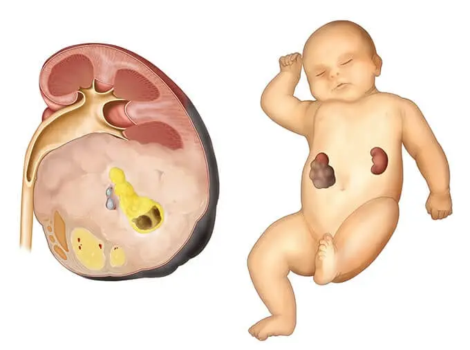 Nutrition for neuroblastoma