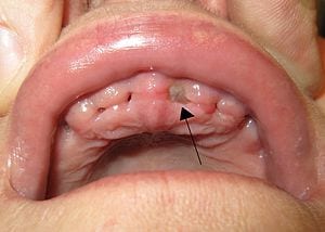 Alveoliti i folesë së dhëmbit