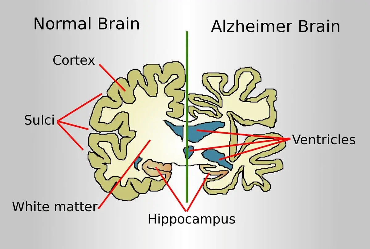 Alzheimer&#8217;s disease