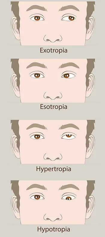 Amblyopia