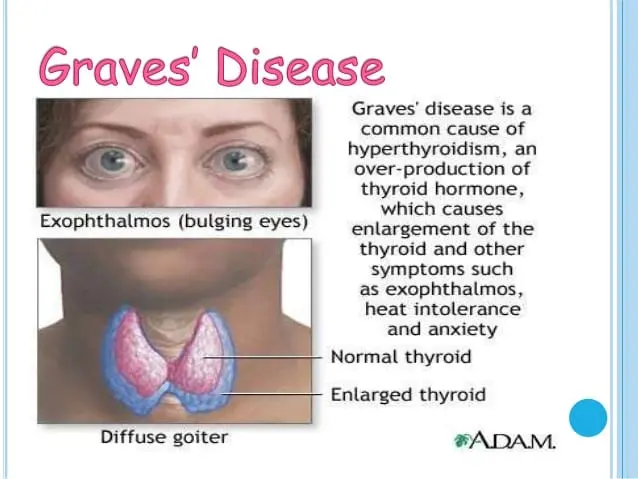 Basedow&#8217;s disease