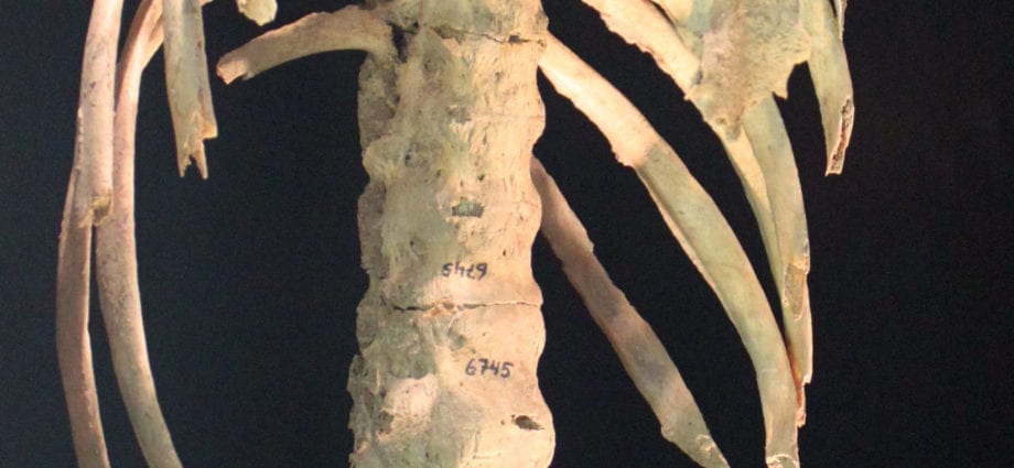 Bechterew-sjúkdómur