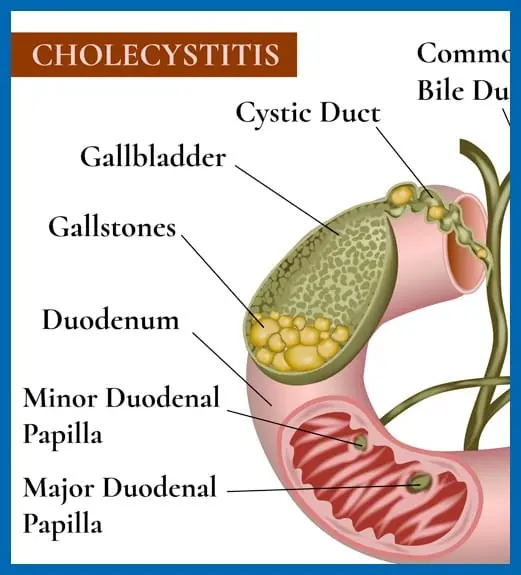 List of diets for illnesses