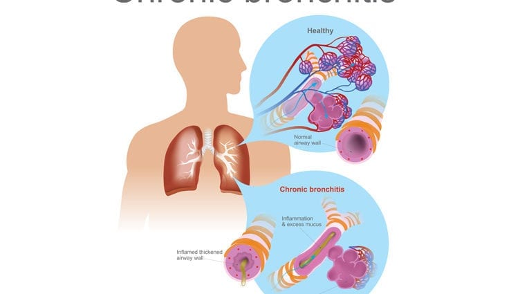 Chronical bronchitis
