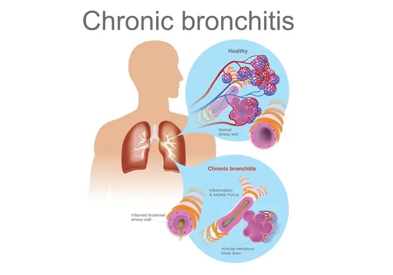 Chronical bronchitis