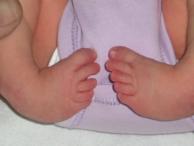 Clubfoot