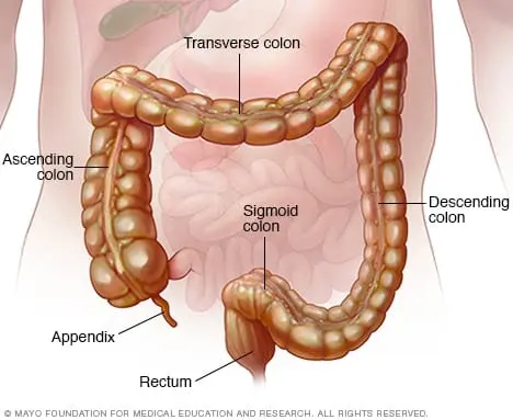 Colitis