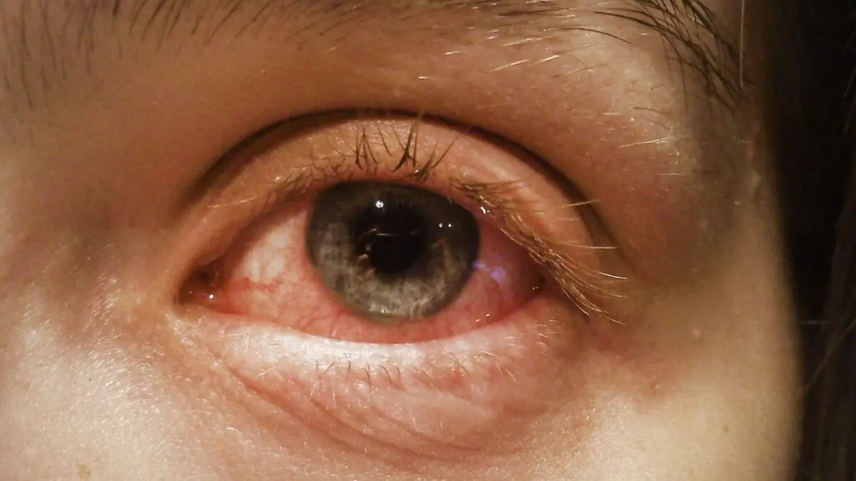 Conjunctivitis