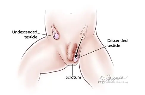 Cryptorchidism