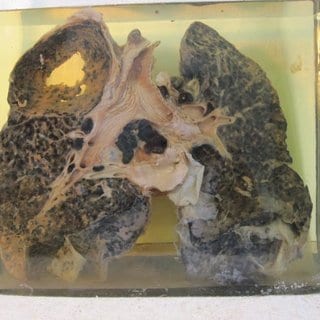 Nutrition for silicosis