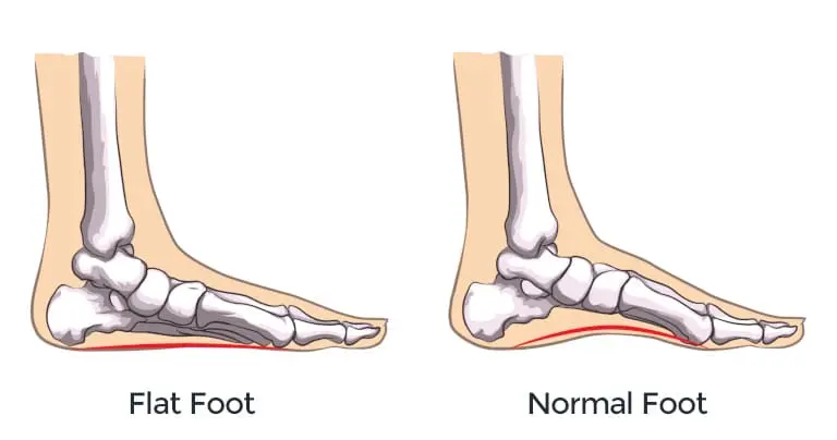 Flat-footedness