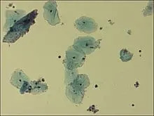 Gardnerellosis