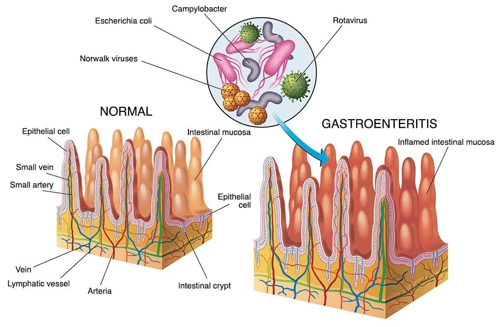 Gastroenteritis