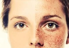 Get rid of freckles and age spots