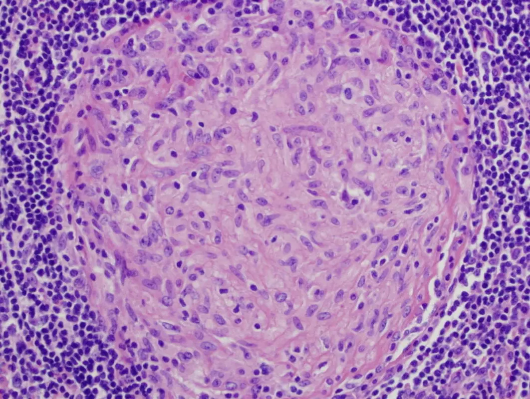 Granuloma