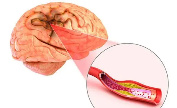 Nutrition for ischemia