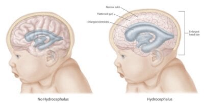 hidrocefalus
