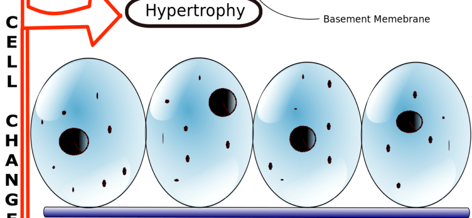 Hiperplazija