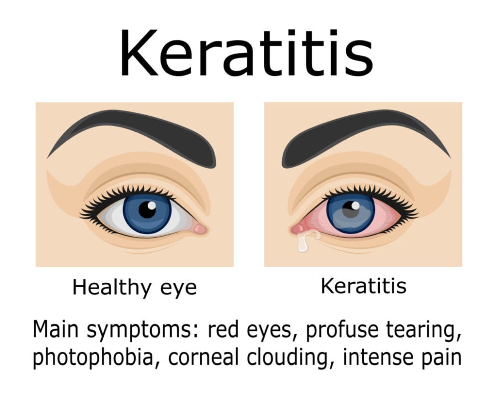 Keratitis Prehrana V Primeru Bolezni In Kontraindikacije