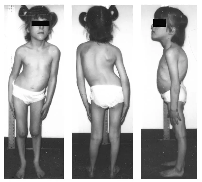 Kyphoscoliosis