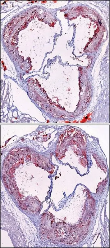 Lack of sleep leads to atherosclerosis