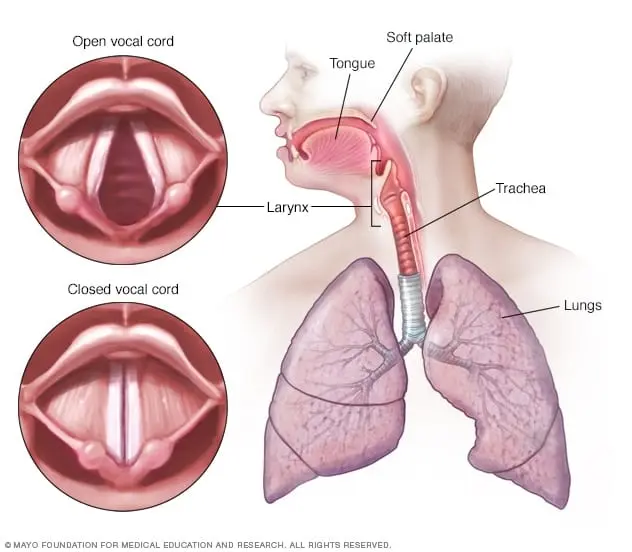 Laryngitis