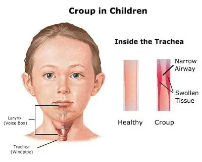 Laryngotracheitis