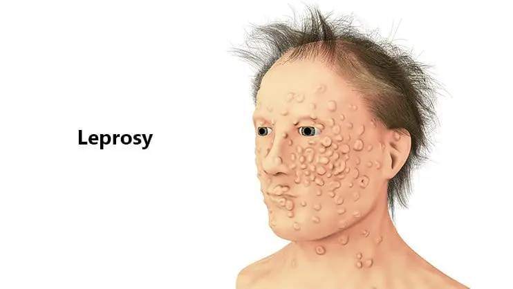 Leprosy