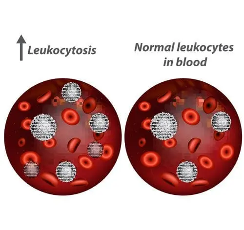 Leukocytosis