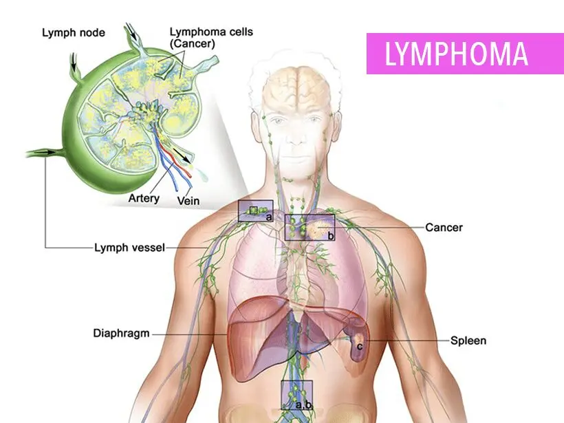 lymphoma