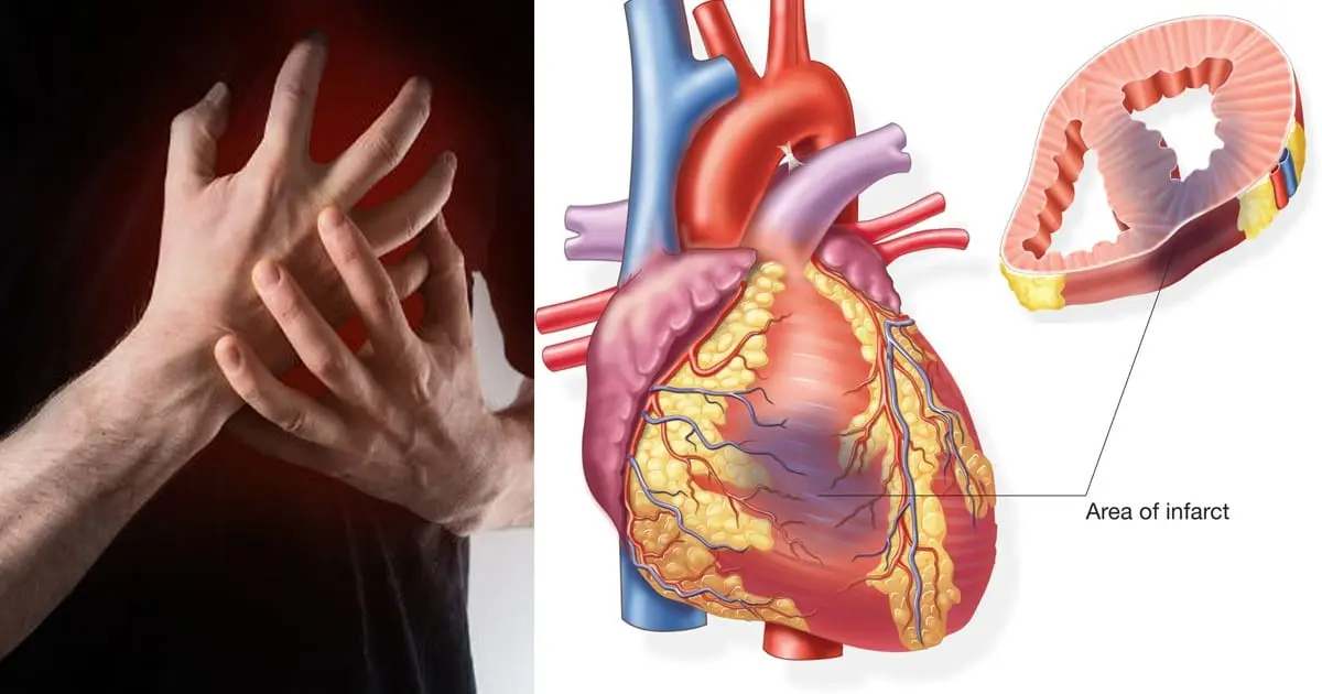 Nutrition for myocardial infarction