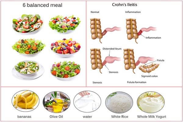 Хранене за болестта на Crohn