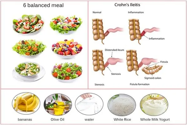 Nutrition for Crohn&#8217;s disease