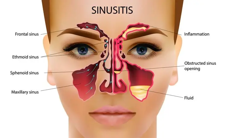 Nutrition for the maxillary sinuses