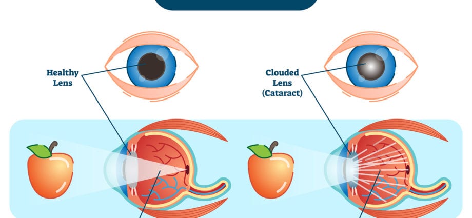 Nutrition in cataracts