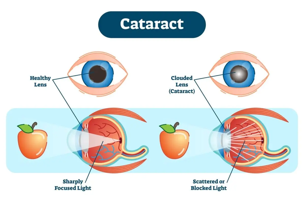 Nutrition in cataracts