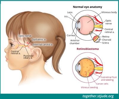 Nafaqada ku jirta retinoblastoma